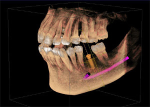 東中野 原歯科医院 では歯科用CTを利用してインプラント治療のシミュレーションを行ってから施述をすることが可能です